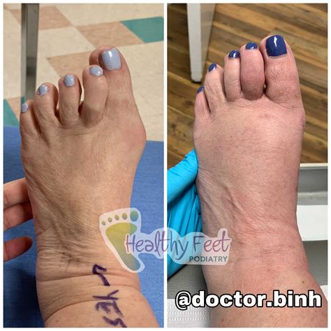 minimally invasive bunion surgery wesley chapel fl