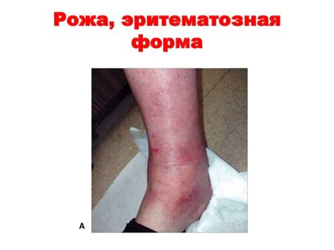 Рожа: клиника, диагностика, лечение - презентация онлайн