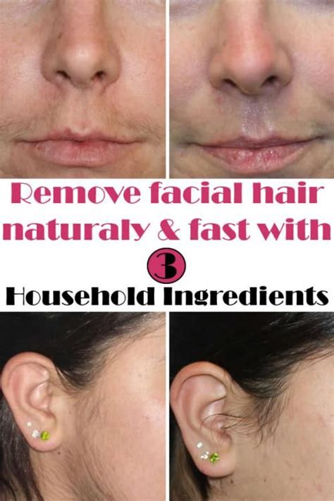 Natural way to remove facial hair | Treat ingrown hair, Facial hair ...