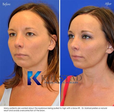 Eyebrow lift case 16 | Dr. Kolstad - San Diego Facial Plastic Surgeon