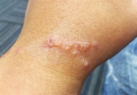 Help! I Have Itchy Blisters on My Skin: Dyshidrotic Eczema – Cottonique ...