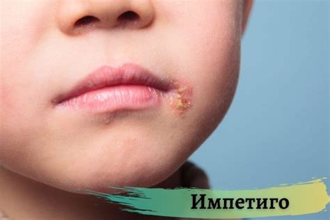 Что такое импетиго у детей и как его лечить? Виды, формы, симптомы и ...