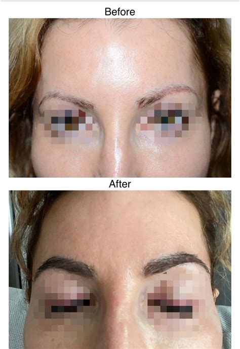 eyebrow hair transplants hair transplant edinburgh