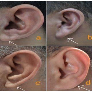 photographs showing   forms   earlobe attachment