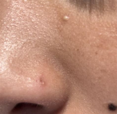 Popped a pimple and left a scar : r/DermatologyQuestions