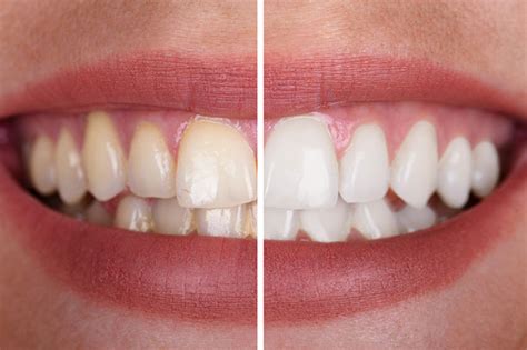 3 Reasons You Should Try Teeth Whitening | Kenneth R. Russell DDS