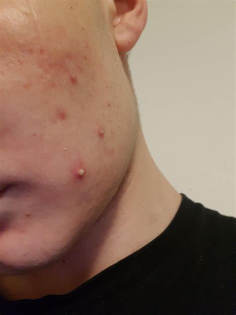[Acne] How do i get rid of giant zits like that? Is popping always