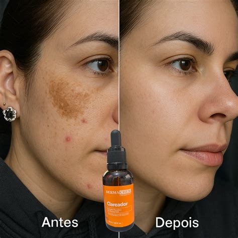 Serum Para Clarear Manchas - SERÚM CLAREADOR MANCHAS ESCURAS TRATA E NUTRE A PELE AJUDA CLAREAR ...