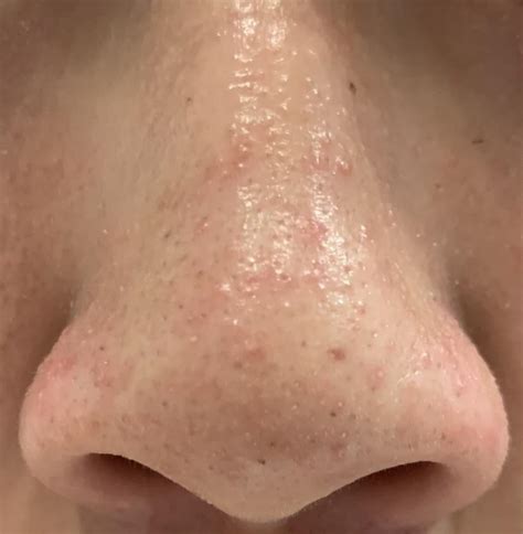 Consistent acne on nose : r/acne