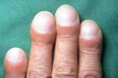 idiopathic pulmonary fibrosis wikipedia