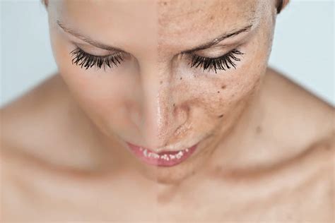 Problems with Pigmentation? These Aesthetic Treatments Can Have You ...