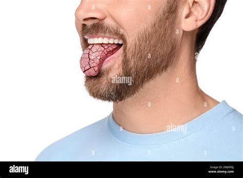 Dry mouth symptom. Man showing dehydrated tongue on white background ...