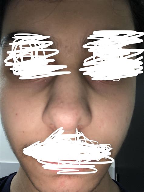 Help me clean my skin.. : r/SkincareAddiction