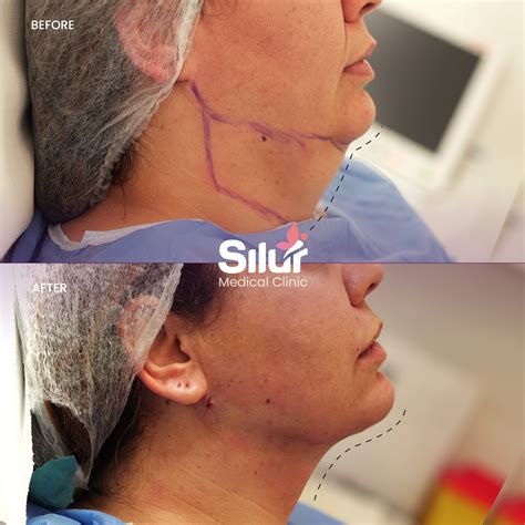 Silur Clinic - Double Chin Liposuction