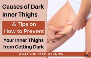 how to clear dark inner thighs