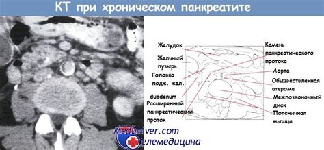 Советы при хроническом панкреатите
