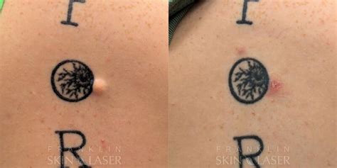 Cyst & Lipoma Removal Before & After Photos in Franklin