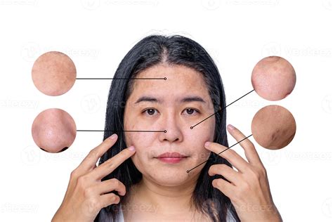 Asian woman face has freckles, large pores, blackhead pimple and scars