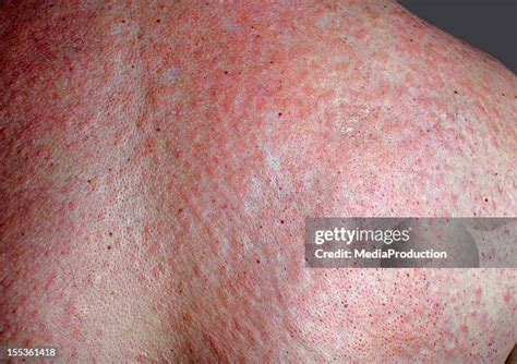 skin rash stock  high res pictures  images getty images