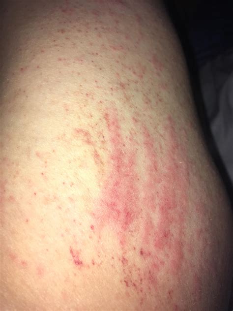 Can Prednisone Help Skin Rash at Emmanuel Jones blog