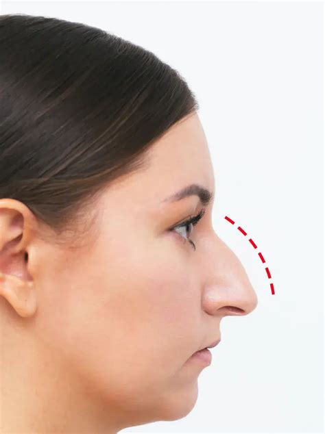 Nose contouring - Clinic Four