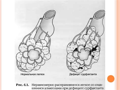 Респираторный дистресс-синдром - презентация онлайн