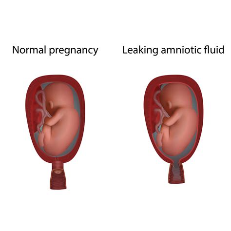 World Prematurity Day: Preterm delivery due to leaking of amniotic