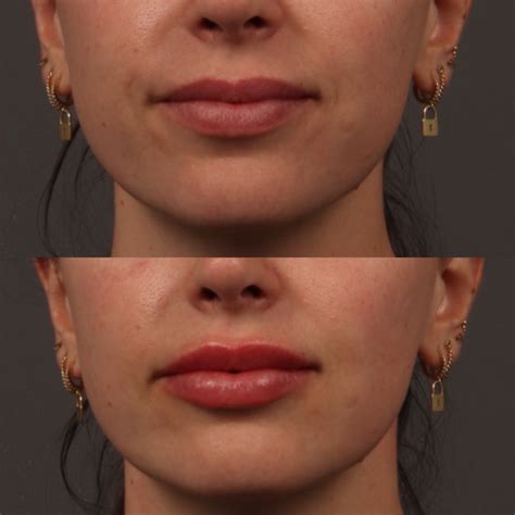 Lip Filler 4 Before & After Photos in Phoenix & Scottsdale, Arizona