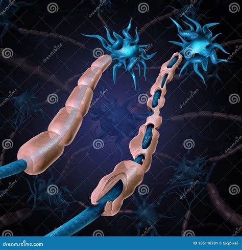 Multiple Sclerosis Damaged Myelin Stock Illustration - Illustration of