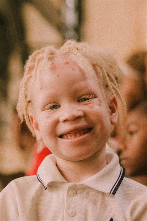 If You’re Politically Correct About Black Albinos being singled out by ...