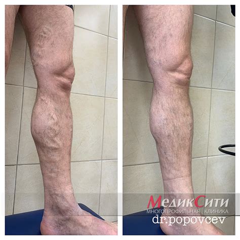 Минифлебэктомия. Отзывы о минифлебэктомии. Цены на операцию ...
