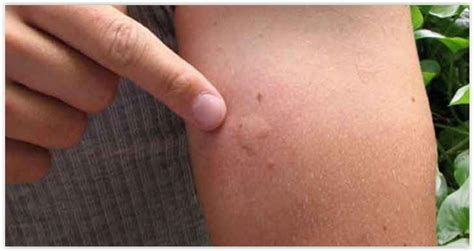 Como Fica A Picada Do Barbeiro - Buenos Aires Municipio: Doença do barbeiro (doença de chagas) ainda não ...