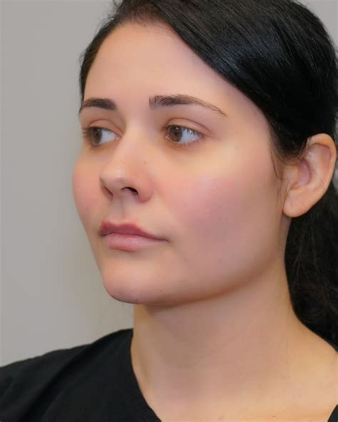 Before & After Photos - Augusta Plastic Surgery