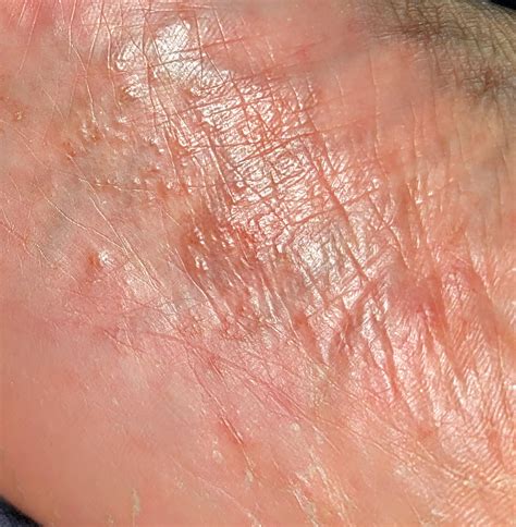 Sudden itchy bumps on sole of right foot : r/DermatologyQuestions