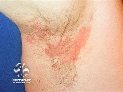 seborrheic dermatitis chest rash