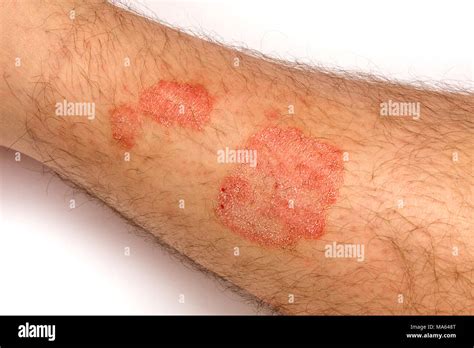 Psoriasis Skin Rash Treatment