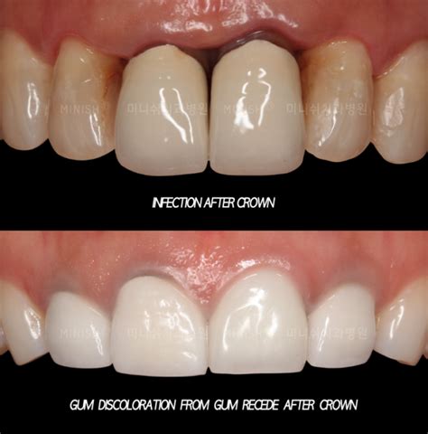 I Got a Crown Retreament - Gum discoloration