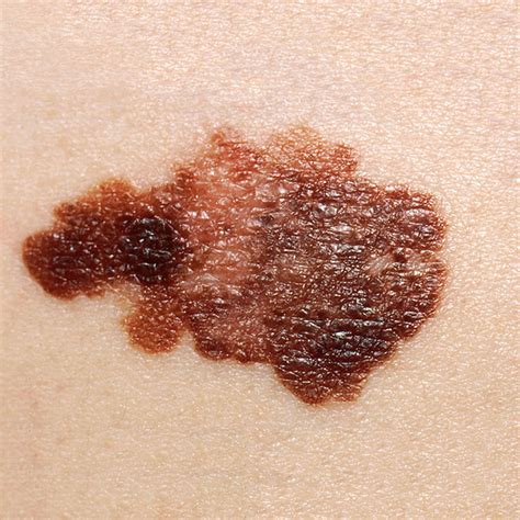 difference   mole  cancer cancerwalls