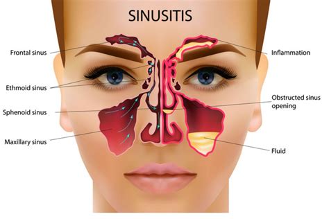 Sinus problems? Natural solutions that work - Patrick Holford