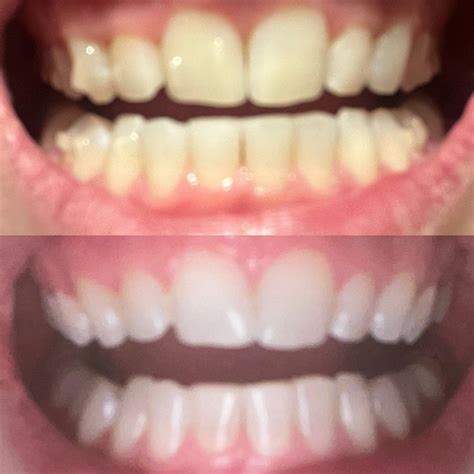 Is anything actually changing? : r/Invisalign