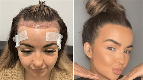 How to Fix a Pushed Back Hairline (Permanently!) - KSL Clinic