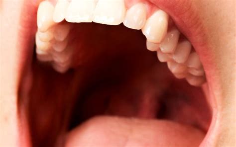 roof   mouth yellow  ultimate answer