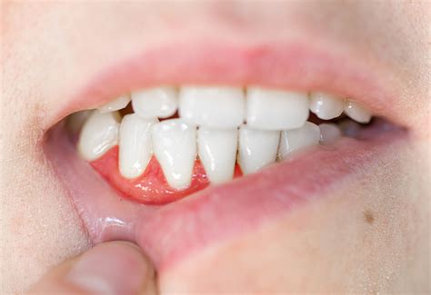 how to tell if you have periodontal disease 3