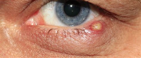 signs   eye infection  cataract surgery