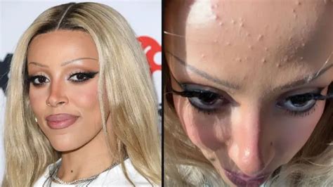 Doja Cat shares unedited photo of her skin after iHeart Radio Award ...