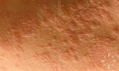 Pityriasis Rosea Skin Rash By Cnri/science Photo Library