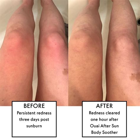 Before And After Sun Tan