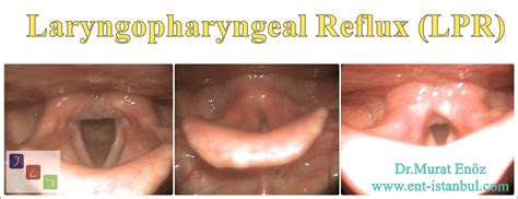 Gastroesophageal Reflux Disease (GERD) - Laryngopharyngeal Reflux (LPR ...