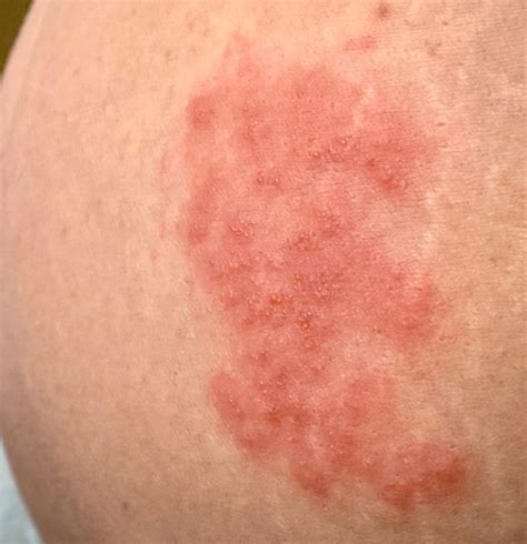 Shingles: what is it and am I at risk?