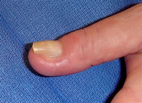 PARONYCHIA FINGER | Hand Surgery Resource